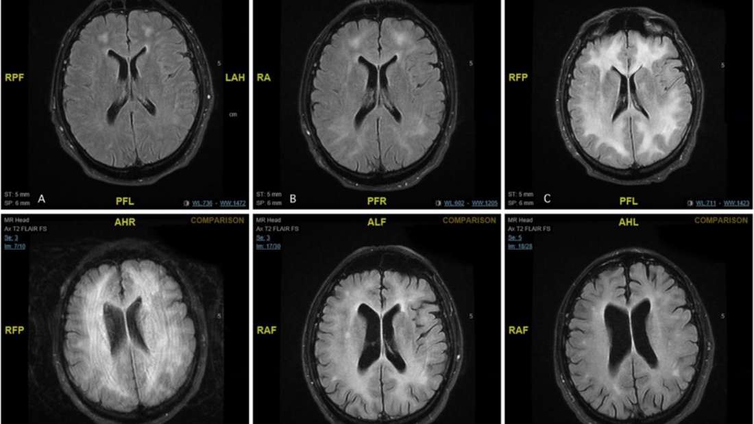 The Strange Way Cocaine Can Kill Your Brain