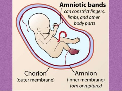 Babies Born With Hand Deformities Spark Investigation