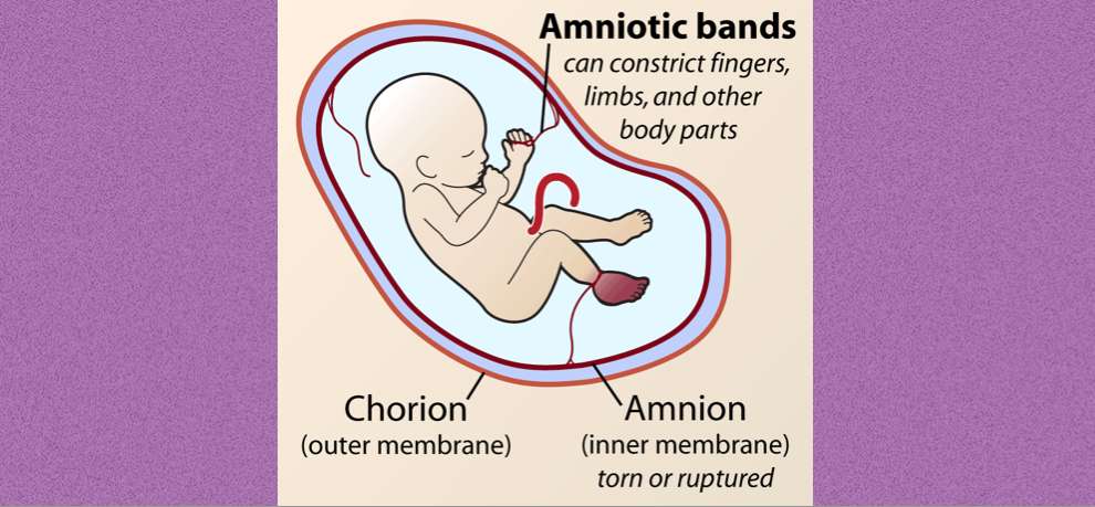 Babies Born With Hand Deformities Spark Investigation